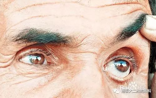 眼內(nèi)進(jìn)了異物應(yīng)當(dāng)怎么處理? 眼內(nèi)進(jìn)了異物應(yīng)當(dāng)怎么處理?