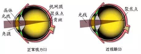 詳解近視、散光、遠視、斜視及弱視