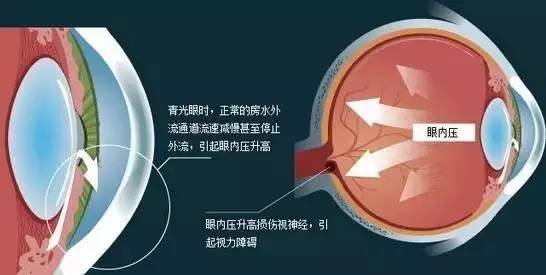 青光眼的三個危險級別，你了解嗎？