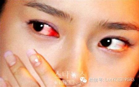 眼睛充血是怎么回事? 眼睛充血是怎么回事?