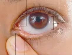 點眼藥水的正確步驟和姿勢