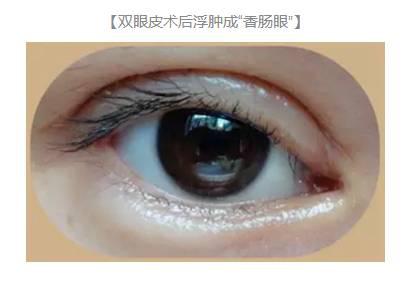 雙眼皮術后出現上瞼下垂怎么辦？