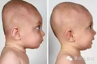 孩子的頭型與睡枕頭有關(guān)系嗎? 孩子的頭型與睡枕頭有關(guān)系嗎?