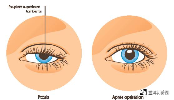 上瞼下垂知多少? 上瞼下垂知多少?