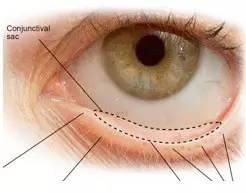 點眼藥水的正確步驟和姿勢