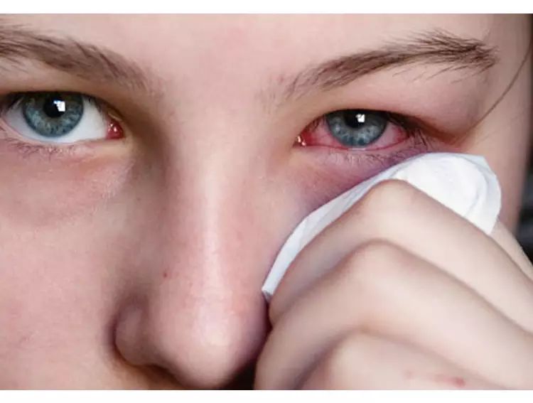 寶寶眼睛紅,是紅眼病嗎? 寶寶眼睛紅,是紅眼病嗎?