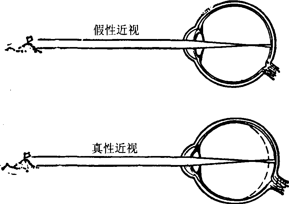 近視不戴眼鏡瞇眼睛都有哪些危害？