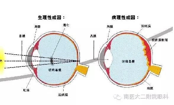 警惕,近視眼更容易得飛蚊癥 警惕,近視眼更容易得飛蚊癥