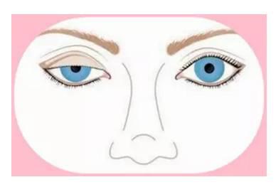 雙眼皮術后出現上瞼下垂怎么辦？