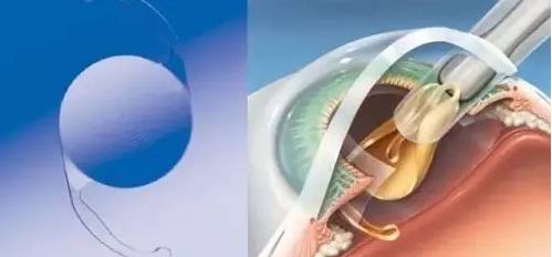 白內(nèi)障患者如何選擇適合自己的手術(shù)晶體? 白內(nèi)障患者如何選擇適合自己的手術(shù)晶體?