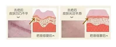 雙眼皮術后出現上瞼下垂怎么辦？