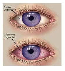 和你談談關于結膜炎的那些事