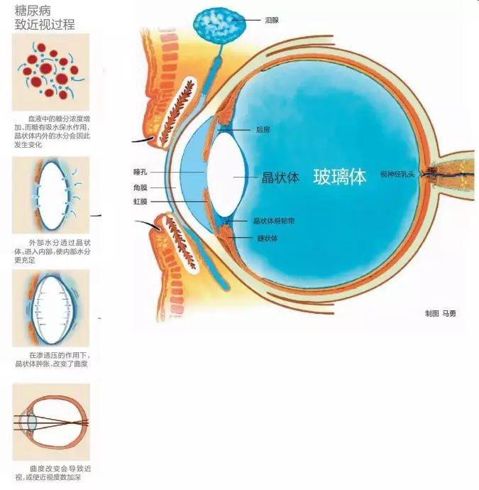 糖尿病會導致眼睛失明,視力模糊是前期征兆! 糖尿病會導致眼睛失明,視力模糊是前期征兆!