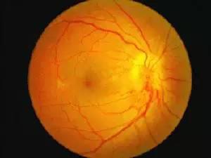 如何預(yù)防糖尿病視網(wǎng)膜病變