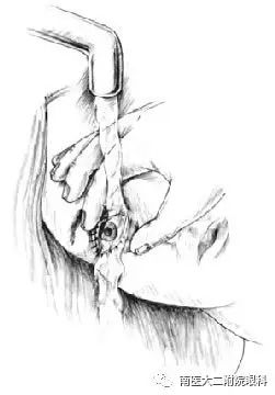 眼內(nèi)進(jìn)了異物應(yīng)當(dāng)怎么處理? 眼內(nèi)進(jìn)了異物應(yīng)當(dāng)怎么處理?