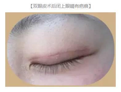 雙眼皮術后出現上瞼下垂怎么辦？