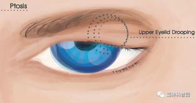 上瞼下垂知多少? 上瞼下垂知多少?