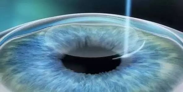 近視手術安全嗎? 近視手術安全嗎?