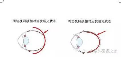 兒童近視防控中更應重視離焦問題 兒童近視防控中更應重視離焦問題