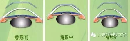 孩子度數(shù)持續(xù)增長(zhǎng)怎么辦？