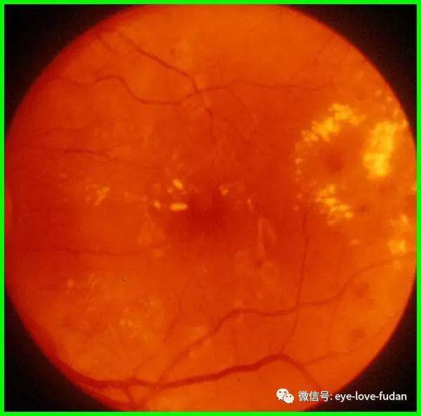 糖尿病眼底病變的病人，請注意！