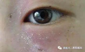 淚道阻塞的癥狀和危害有哪些？