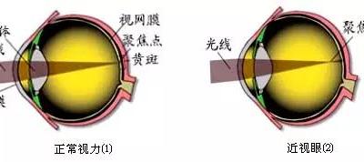 詳解近視、散光、遠視、斜視及弱視