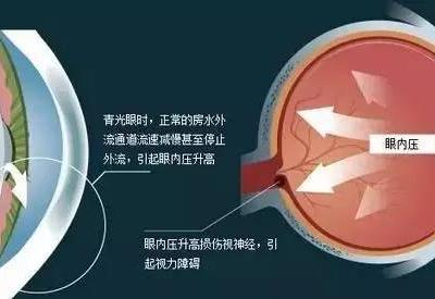 不要忽視青少年假性近視
