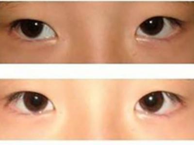 孩子眼睛模糊,就是近視?