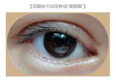 雙眼皮術后出現上瞼下垂怎么辦?