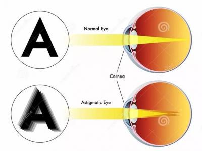 和你談?wù)勱P(guān)于結(jié)膜炎的那些事