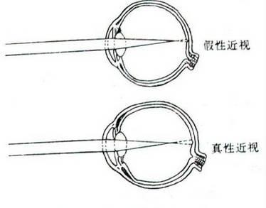 如何辨別真性近視和假性近視?