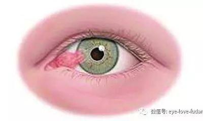 人眼為什么會長“多肉”？