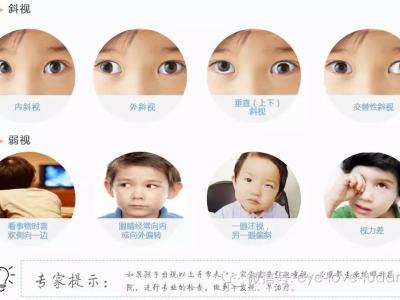 孩子斜弱視治療，不要錯過關鍵時機