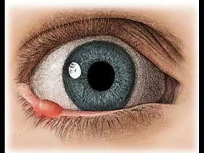 孩子長針眼怎么辦?