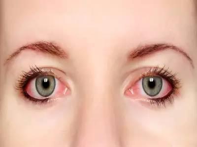 眼睛出現(xiàn)紅血絲怎么辦?