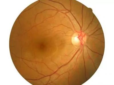 白內障術后仍然模糊怎么回事?