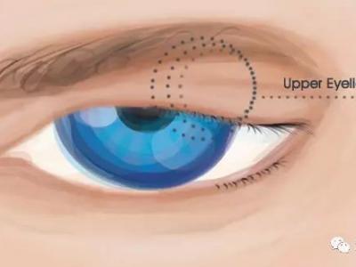 上瞼下垂知多少？