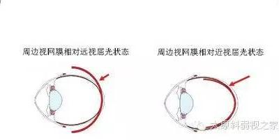 兒童近視防控中更應重視離焦問題