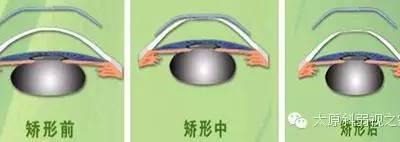 孩子度數(shù)持續(xù)增長怎么辦？