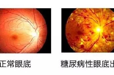糖尿病會導致眼睛失明,視力模糊是前期征兆!