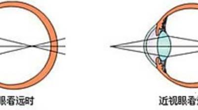 眼疲勞防治，你需要知道的那些事