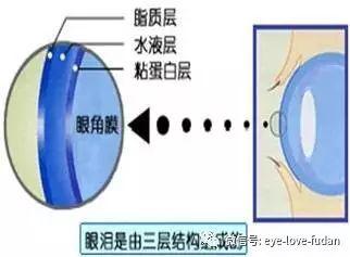 干眼癥就是眼睛缺水嗎？