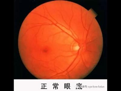 什么度數(shù)一直增加?戴鏡度數(shù)加深的五大原因!