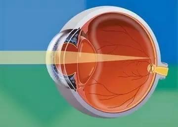 眼睛為什么會(huì)散光？