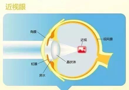 近視的原因、預防與治療 近視的原因、預防與治療