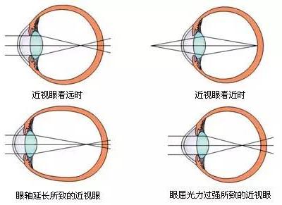 適齡兒童不論視力好壞都應該驗光