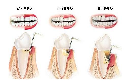 為什么會有牙周病?牙周病的中醫(yī)治療和保養(yǎng)方法-易網(wǎng)<a href=http://www.xllyou.com/ target=_blank class=infotextkey>健康養(yǎng)生</a>網(wǎng) 為什么會有牙周病?牙周病的中醫(yī)治療和保養(yǎng)方法