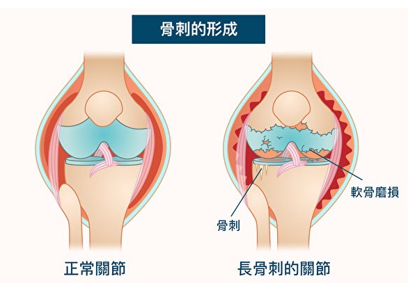 長骨刺有哪些原因？從中醫角度來看骨刺的預防與緩解方法