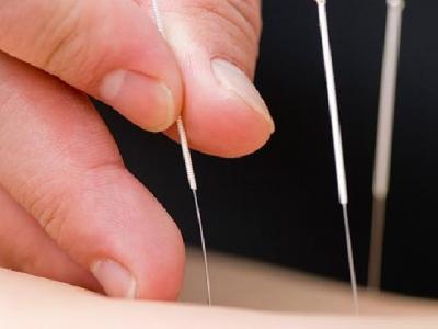 治療內(nèi)分泌失調(diào)針灸有效嗎? 中醫(yī)針灸治療內(nèi)分泌失調(diào)效果好